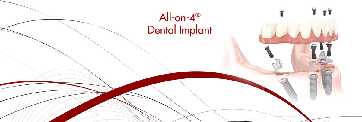 Dubuque All-on-4 Dental Implants