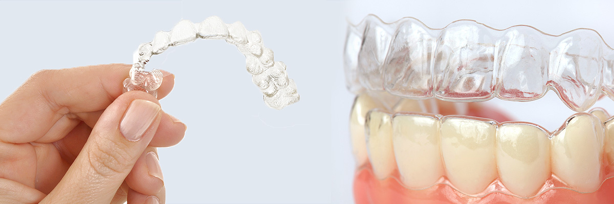 Dubuque Alternative to Braces for Teens