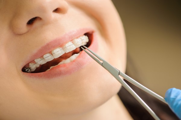 What To Ask Your General Dentist About Ceramic Braces For Teeth Straigtening