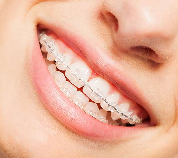 Dubuque Invisible Orthodontics