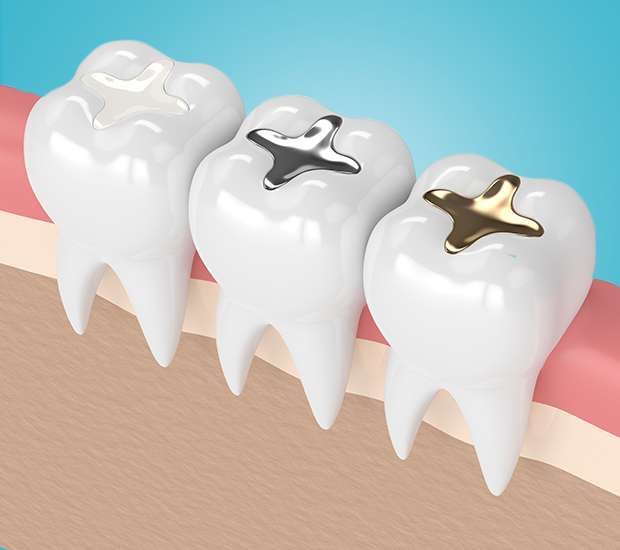 Dubuque Tooth Colored Fillings