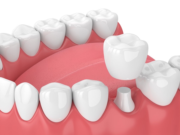 Commonly Asked Dental Crowns Questions