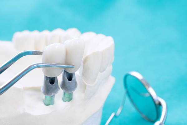 How Many Visits Does It Take To Get A Dental Crown?