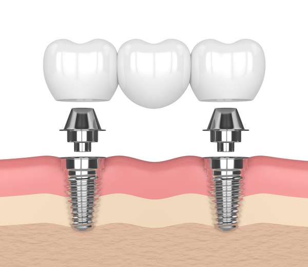 Dental Implants Dubuque, IA