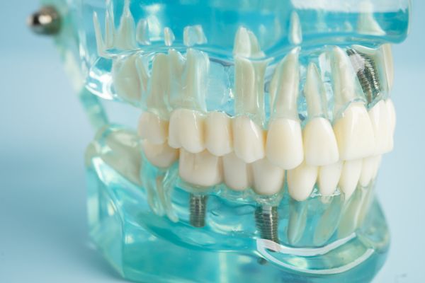 Am I A Candidate For Implant Restoration?