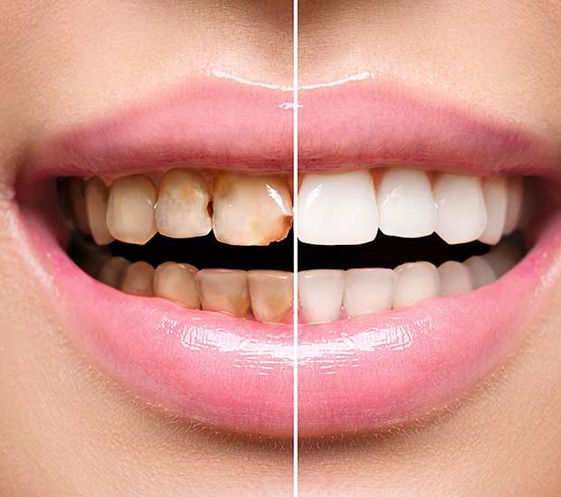 Dubuque Dental Implant Restoration