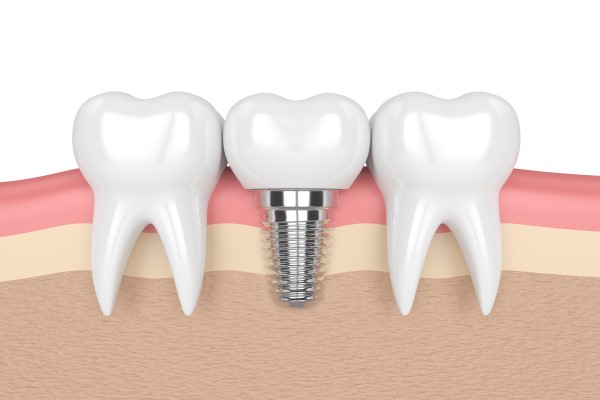 FAQs About Tooth Implants