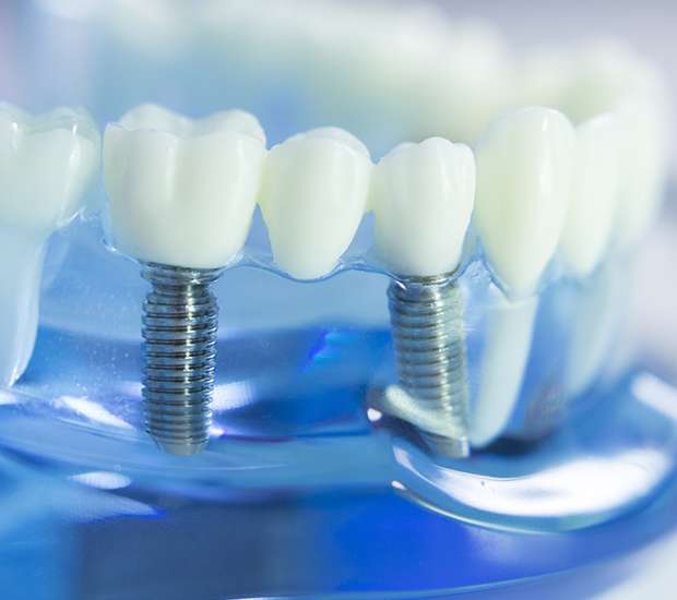Dubuque Dental Implants