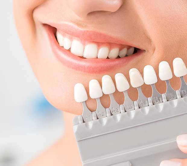Dubuque Dental Veneers and Dental Laminates
