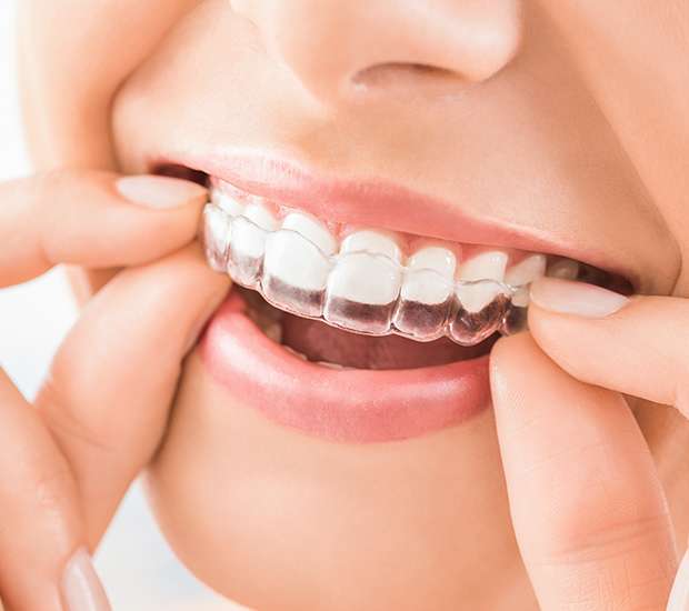 Dubuque Does Invisalign® Really Work?