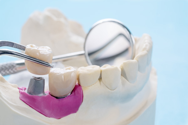 Benefits Of Visiting An Implant Dentist