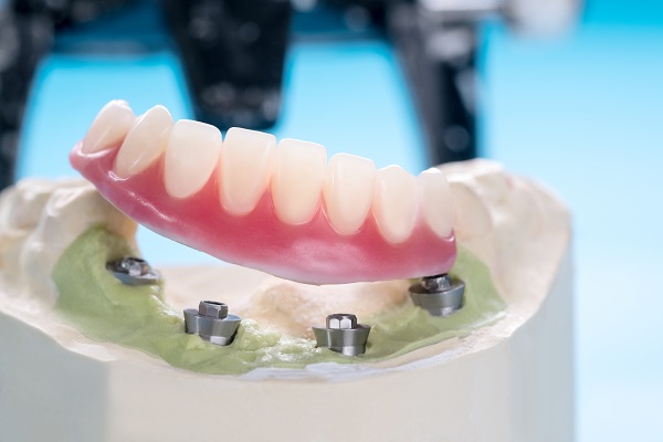 Missing Teeth Replacement: Implant Supported Dentures