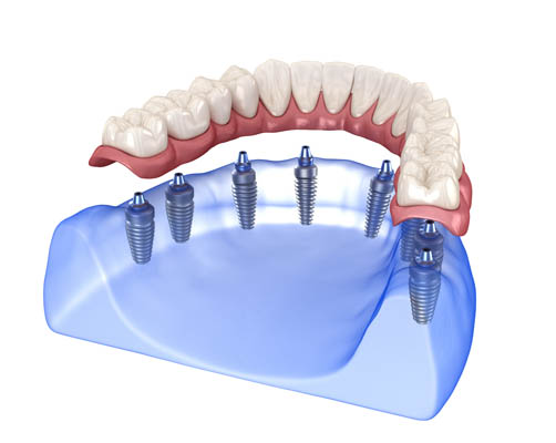 Implant Supported Dentures Dubuque, IA