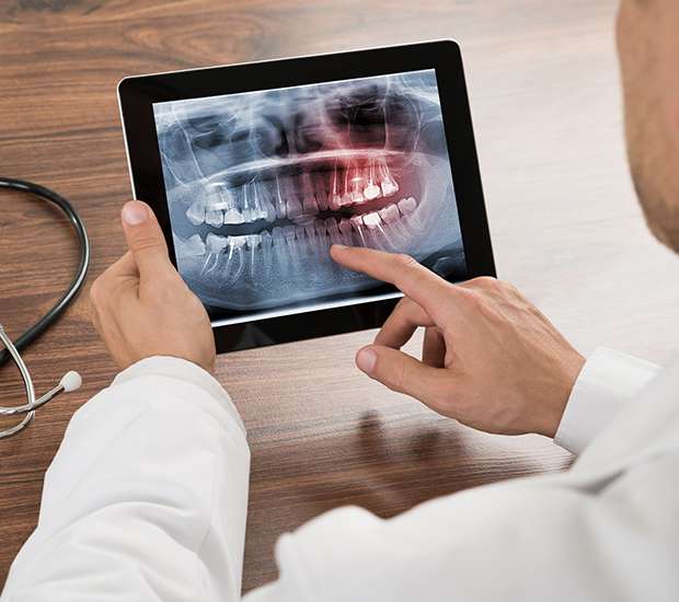 Dubuque Types of Dental Root Fractures