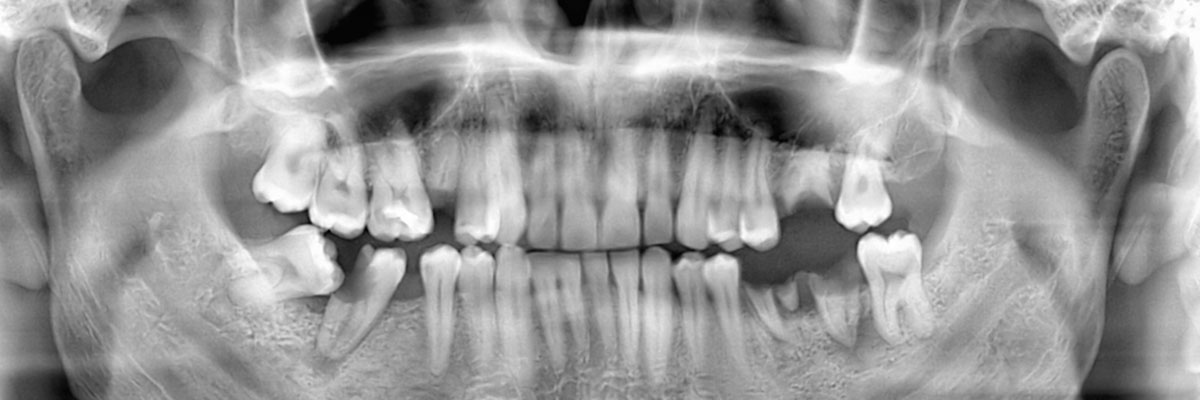 Dubuque Wisdom Teeth Extraction